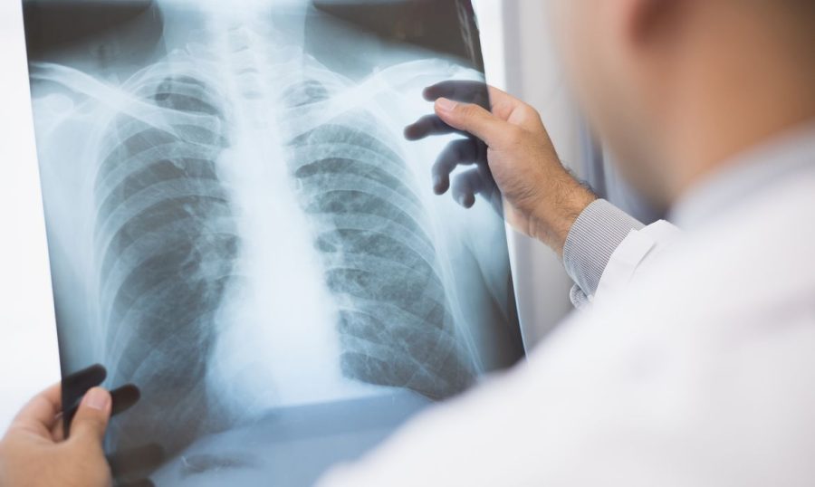 Anvisa aprova novo medicamento para câncer de pulmão avançado