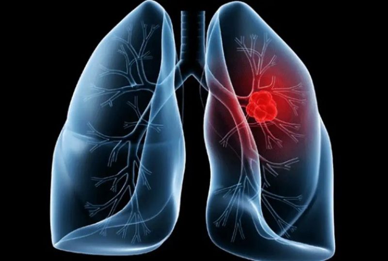Entenda o adenocarcinoma pulmonar, tumor que acomete o papa