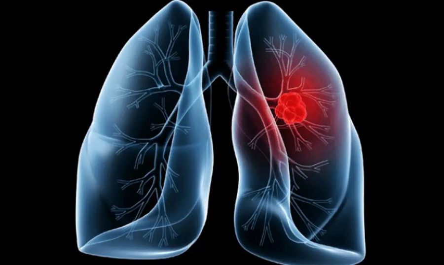 Entenda o adenocarcinoma pulmonar, tumor que acomete o papa